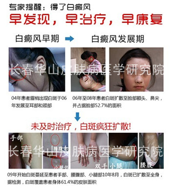 白斑复发欲赴长春就医,家人打通康复通道获援助
